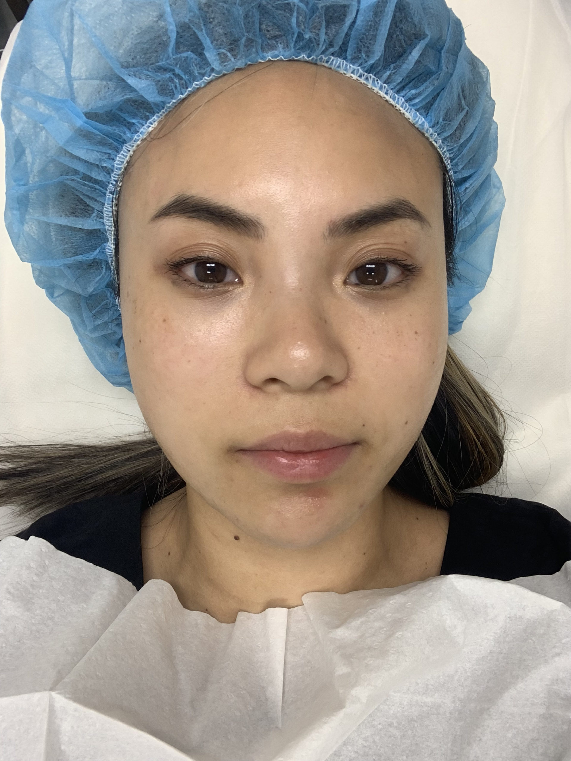en-route mesotox treatment before
