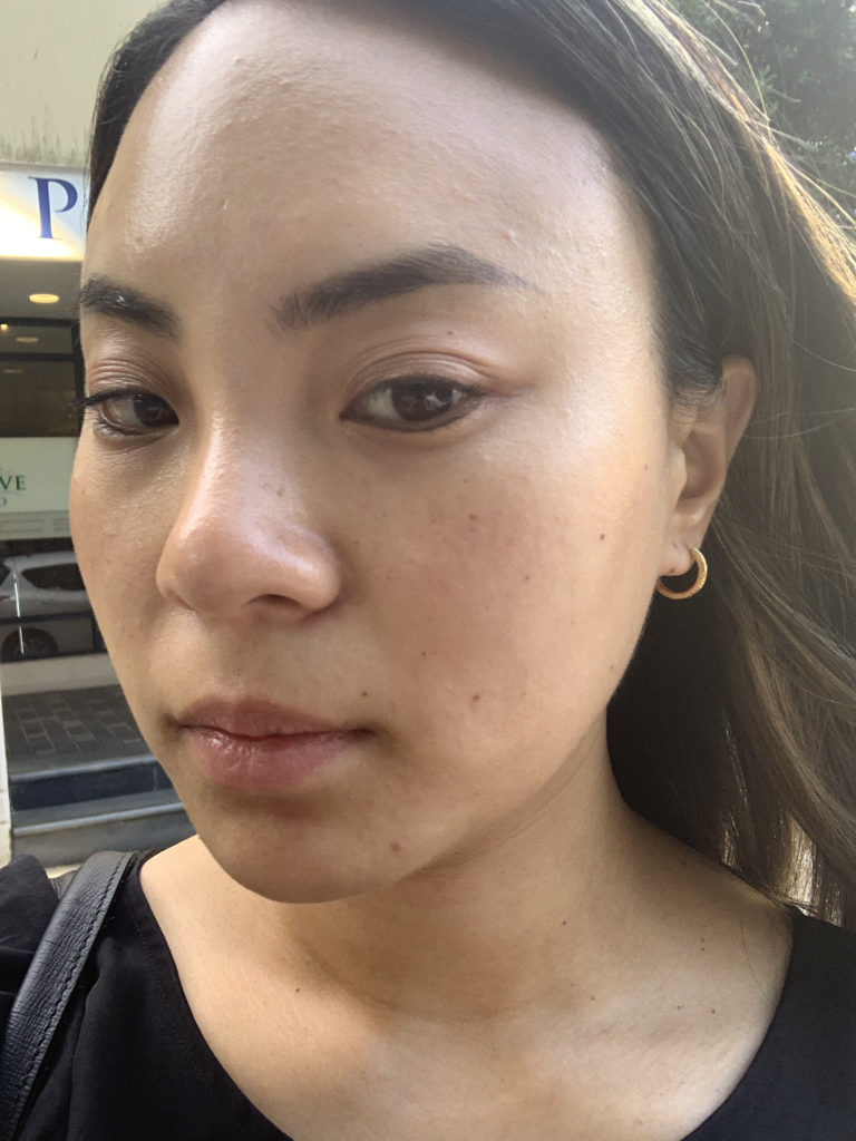 en-route mesotox treatment after