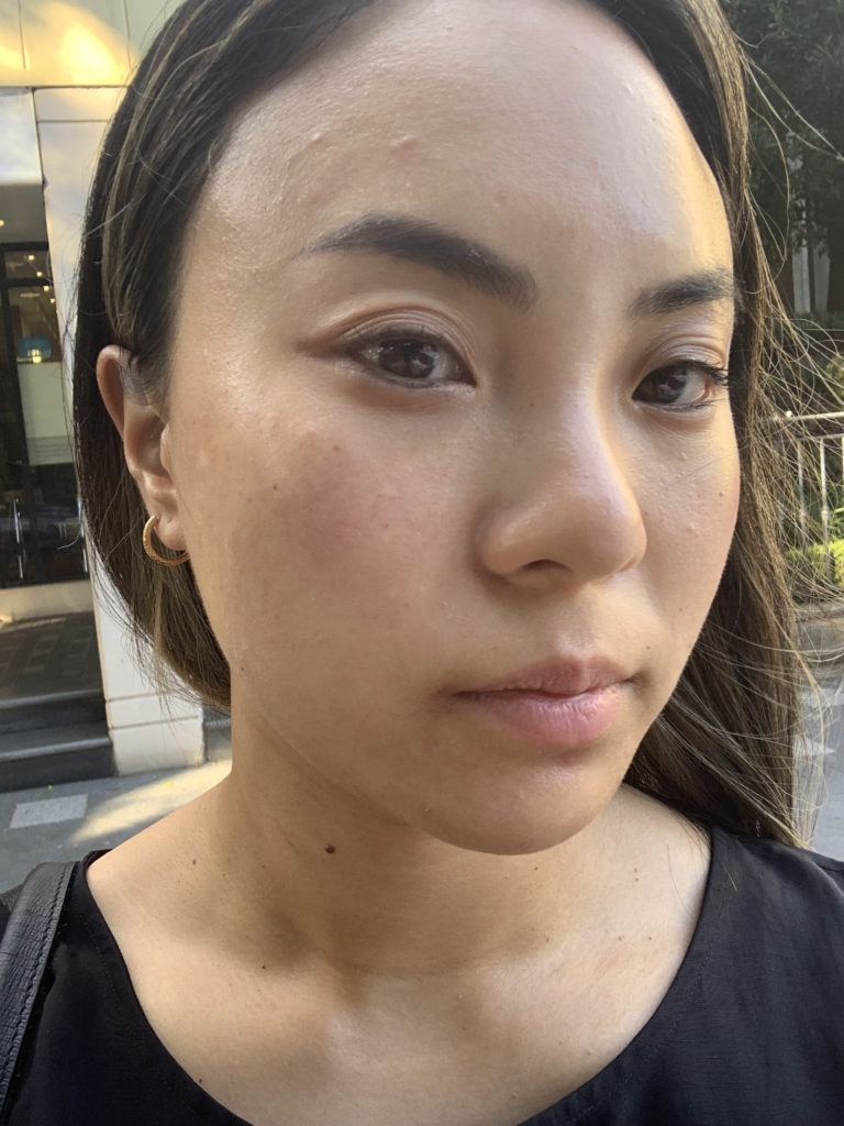 en-route mesotox treatment after