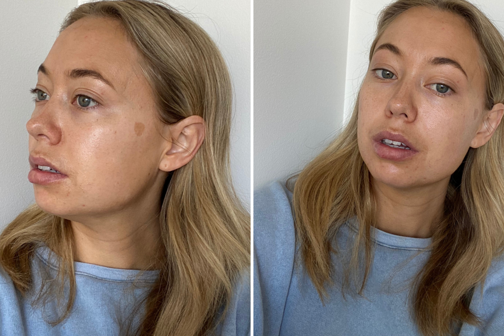 This One Face Peel Cleared My BlemishProne Skin En Route