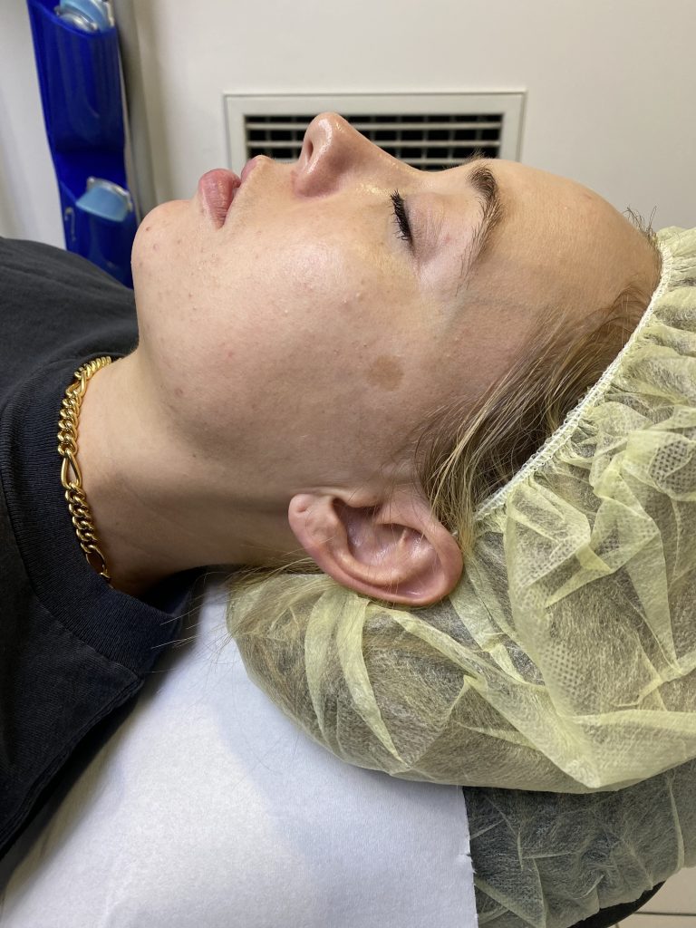 Anti ageing peel en-route