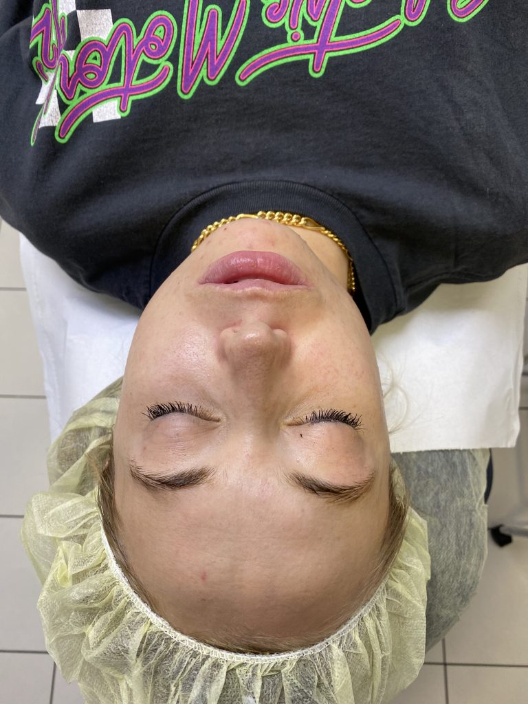Anti ageing peel en-route